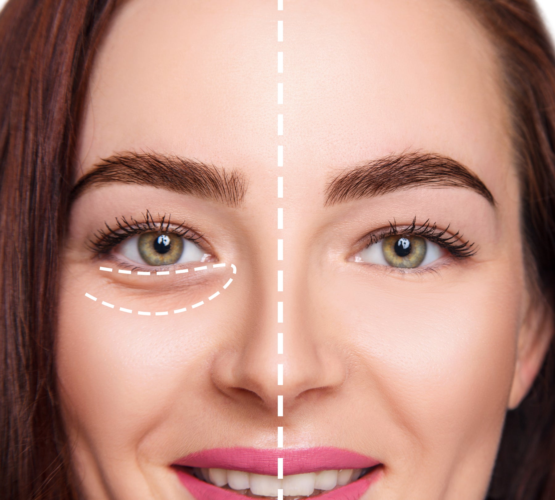 Sunekos the injectable treatment to target undereye bags, dark circles and wrinkles.  Fight the signs of aging with this amazing undereye cosmetic treatment using hyaluronic acid and amino acids.  Book Now Belfast and Newry Clinics